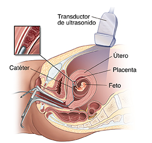 Vista lateral de pelvis femenina donde se observa el muestreo transcervical de vellosidades coriónicas.